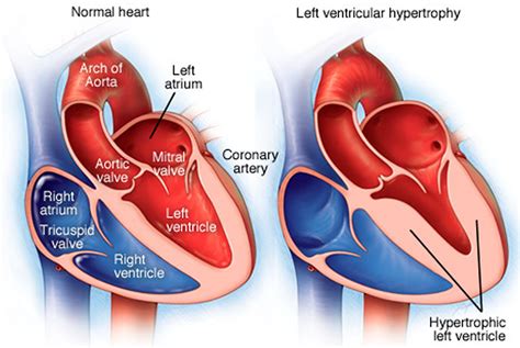 mild concentric lvh is dangerous